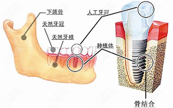 长沙深圳瑞士ITI种植牙 牙槽骨条件要求详解