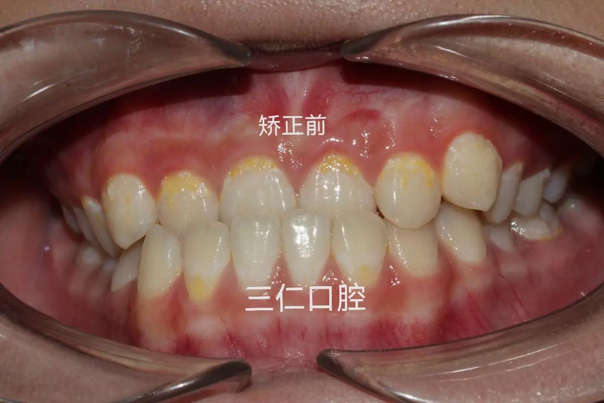 长沙种一颗牙矫正价格是多少 看完这篇心里有数