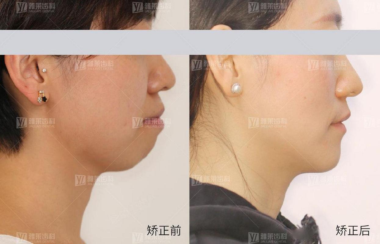 长沙矫正牙齿对脸型的改变到底有多大？真实对比告诉你