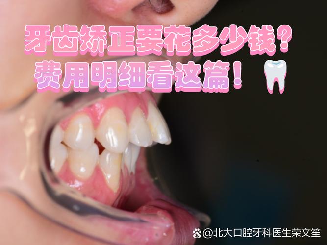 长沙广州牙齿矫正到底要花多少钱？看完这篇不踩坑