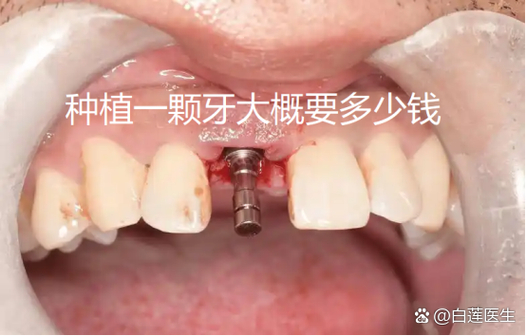 长沙纯钛种牙多少钱一颗？费用明细和影响因素都在这里