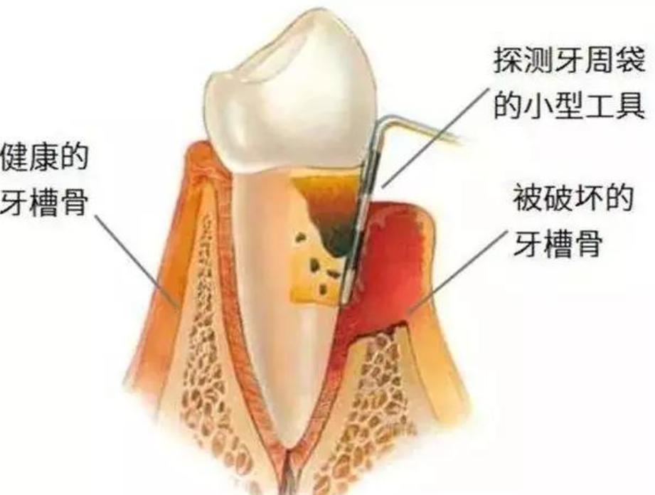 长沙深圳牙槽骨太薄种牙有救吗?医生说实话