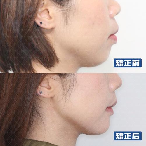 长沙35岁牙齿还能矫正吗 成人矫正效果看这里