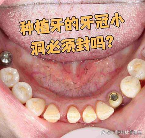 长沙深圳龙华全口种牙当天戴牙冠靠谱吗