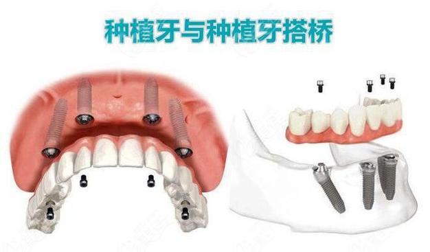 长沙种植牙还是搭桥哪个更好