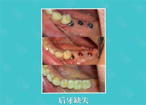 长沙龙岗中心城种植牙医院怎么选 本地人的真实推荐