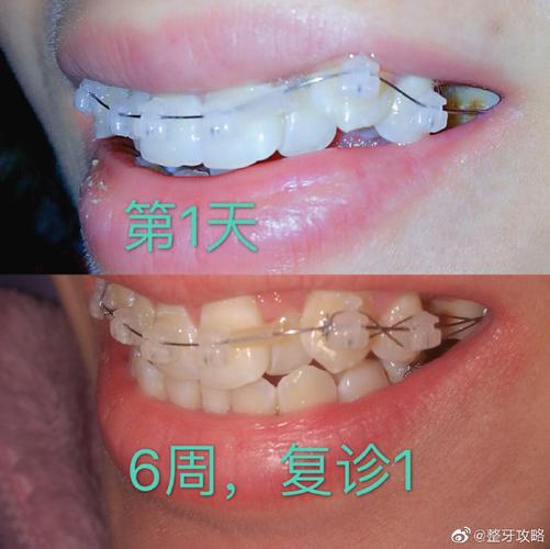 长沙深圳牙缝过大矫正多少钱 价格表一览