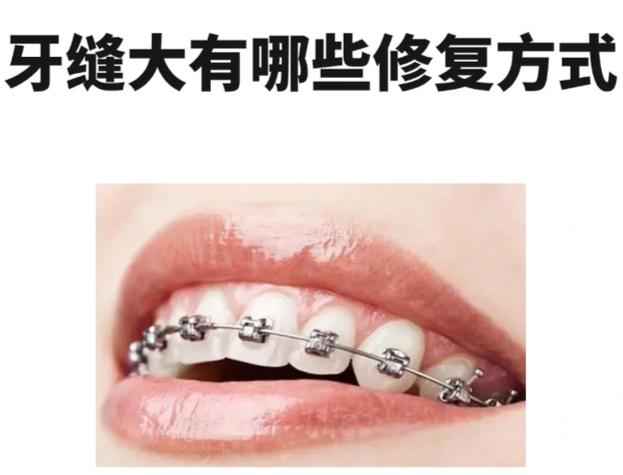 牙齿矫正牙缝大价目表_矫正牙缝过大的费用是多少_深圳牙缝过大矫正报价