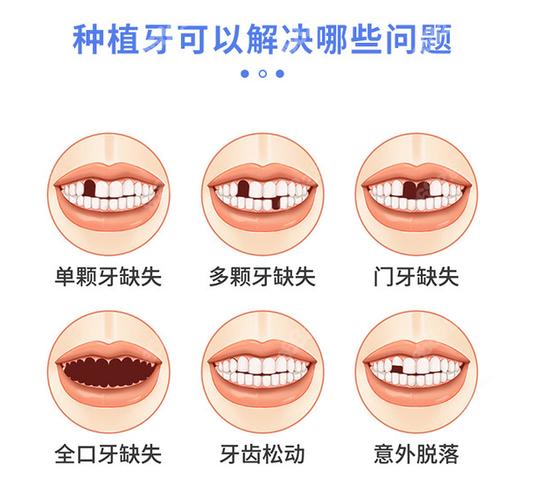 长沙宝安新安种植牙哪家医院好？靠谱选择看这几点