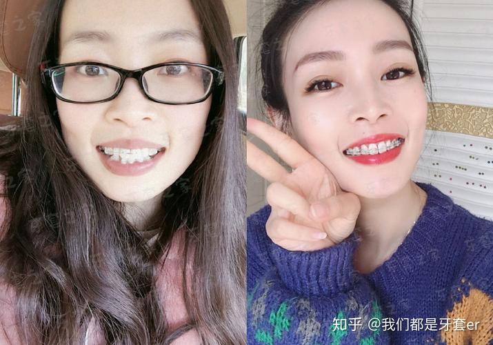 牙齿矫正案例分享_40岁矫正牙齿的案例_牙齿矫正案例严重