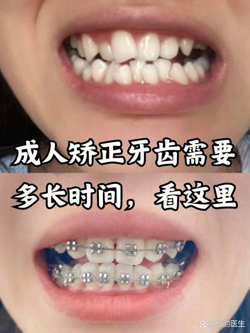 长沙41岁做牙齿矫正晚不晚？成人正畸真实经历分享