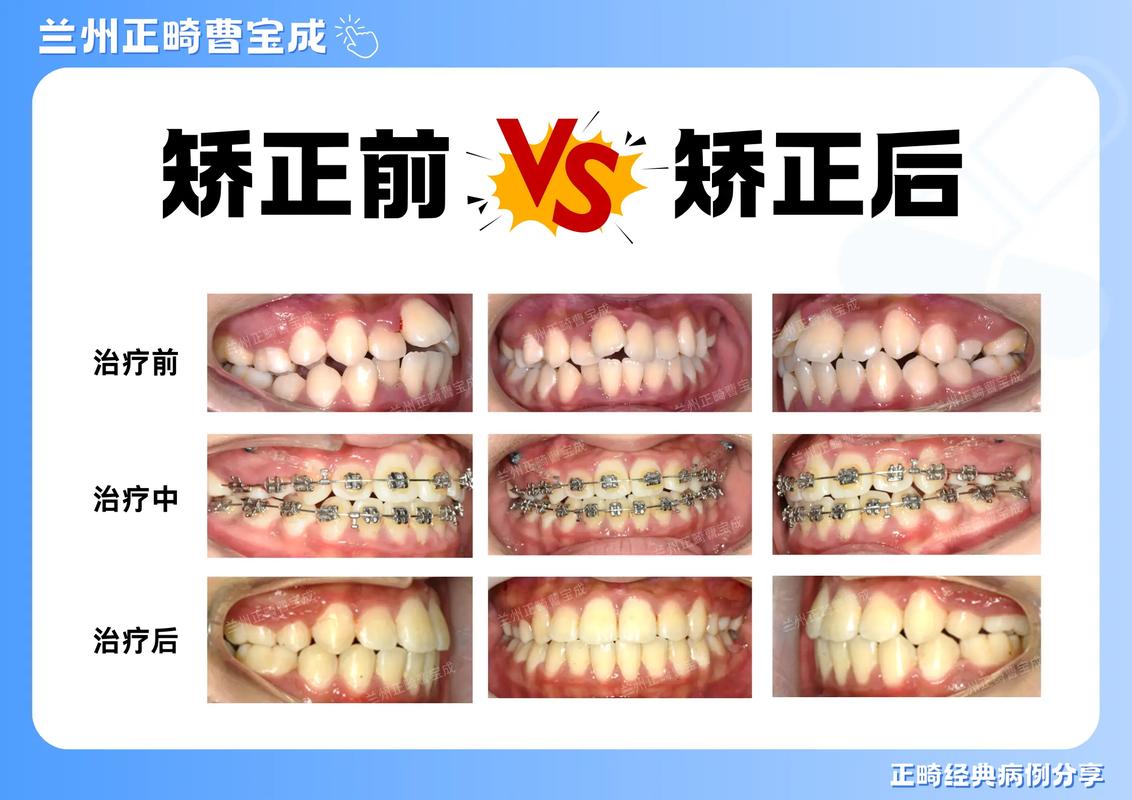 长沙20岁矫正牙齿的利与弊 成年人整牙值不值