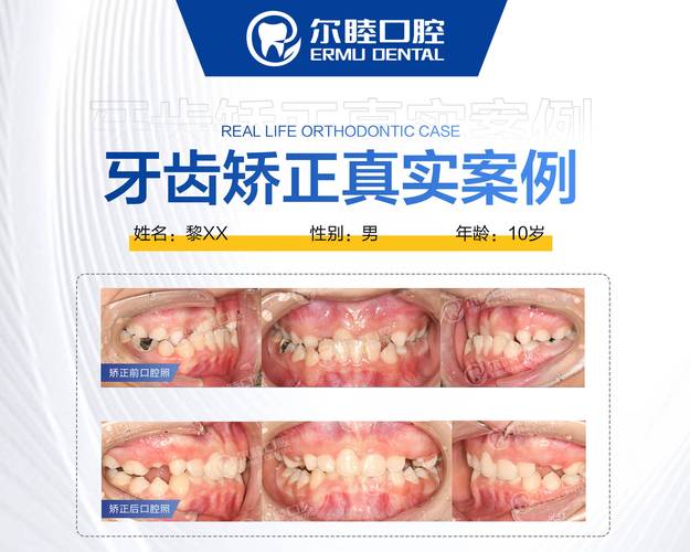 长沙深圳龙华钢丝矫正哪里好？选对牙科很关键