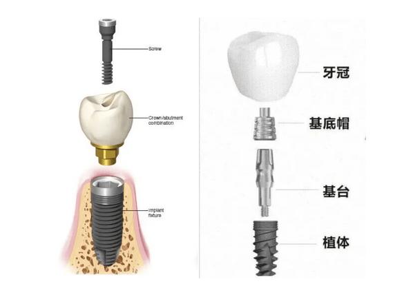 长沙种牙全过程要多久？看完心里有数
