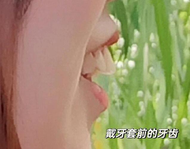 长沙深圳骨性龅牙正畸选哪家医院？骨科正畸避坑全攻略