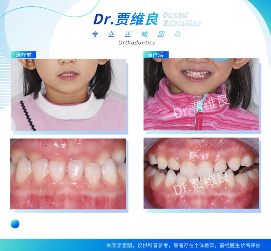 长沙儿童牙齿校正几岁开始做合适?