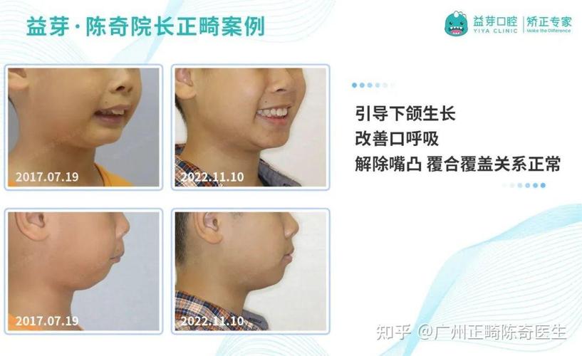 长沙东莞儿童牙齿矫正几岁开始最好？家长别等换完牙才后悔