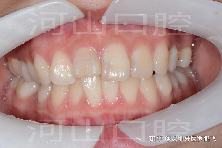长沙20岁牙齿还能不能矫正？成年人正畸真实情况揭秘