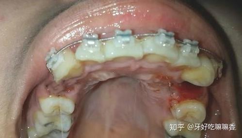 长沙宁波青少年牙齿矫正选哪家？费用多少？看完这篇就明白