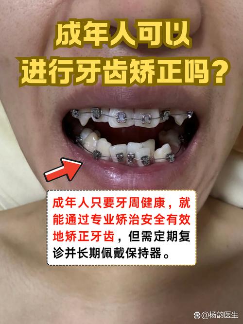 长沙30岁矫正牙齿还来得及吗 成年人正畸必看