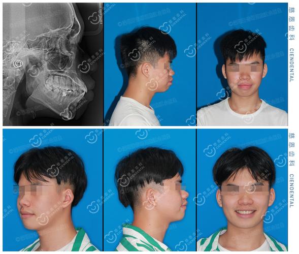 长沙深圳罗湖骨性龅牙隐形矫正能行吗？方案详解