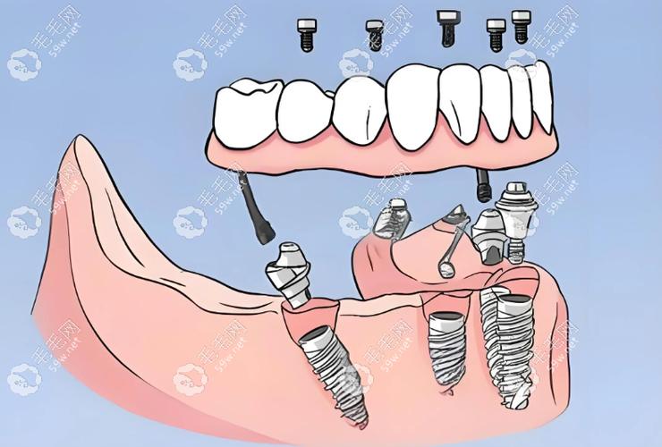 深圳诺贝尔种植牙门诊价格_诺贝尔门诊牙种植深圳价格表_诺贝尔牙科种植牙价格