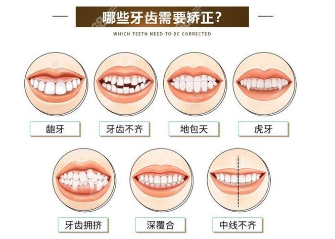 长沙深圳儿童地包天几岁矫正最好