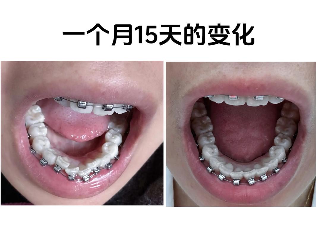 长沙30岁还能做牙齿矫正吗 成年正畸晚不晚