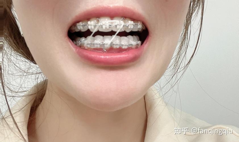 长沙27岁做牙齿矫正还来得及吗