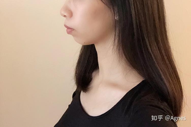 长沙深圳龙岗隐适美矫正要多久？看完这篇就清楚了