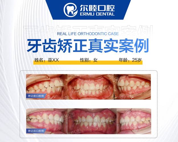 长沙深圳宝安金属自锁托槽矫正哪里好？公立和私立医院怎么选