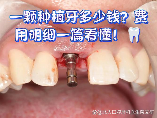 长沙深圳种牙贵不贵？揭秘诺贝尔种植牙门诊真实收费明细