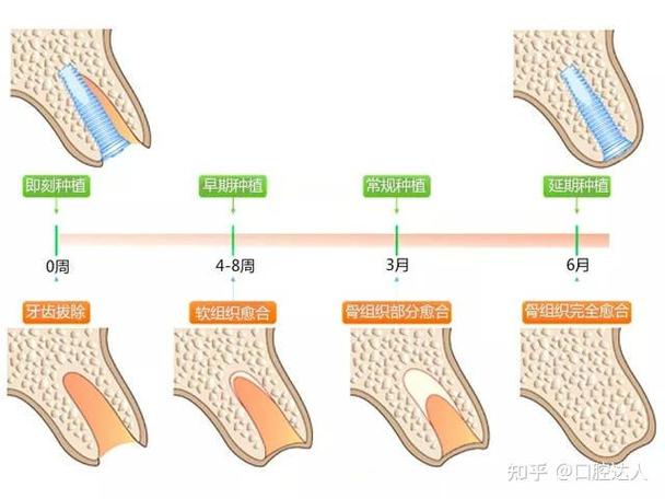 长沙掉3颗牙怎样种植？种牙流程全解析+费用避坑指南