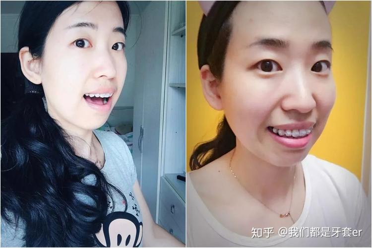 长沙30岁做牙齿矫正晚不晚？真实情况告诉你