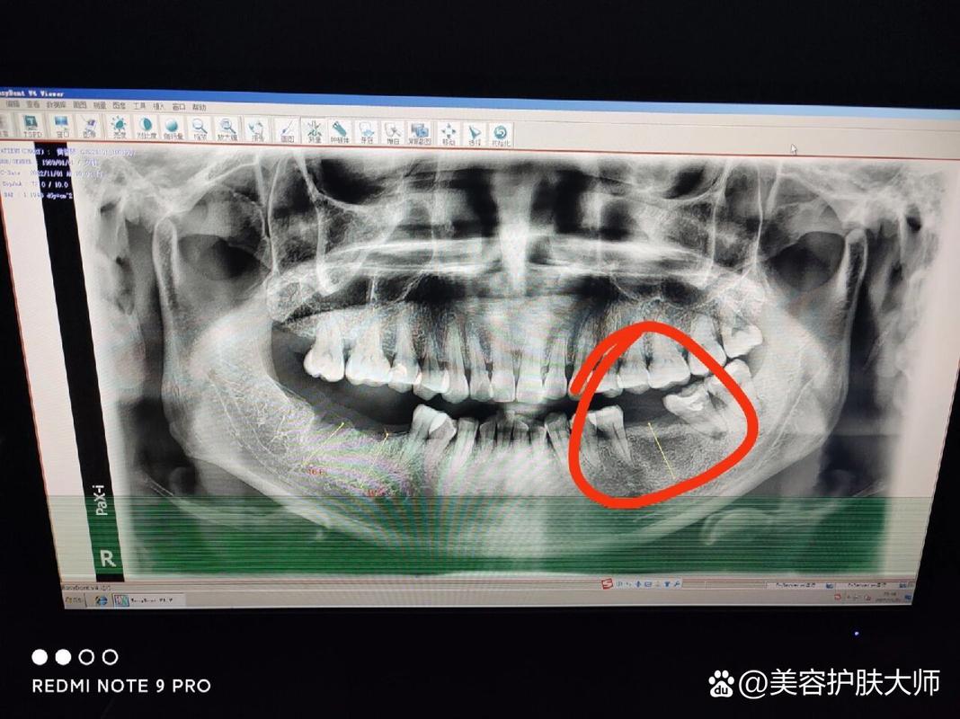 长沙深圳皓圣种植牙医院靠谱吗 真实推荐指南