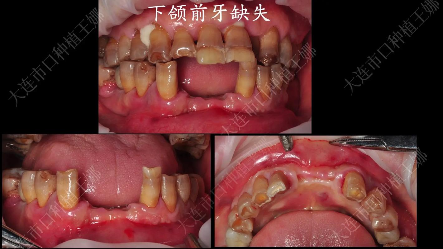 长沙拔前牙能整好牙吗？真相与风险全解析