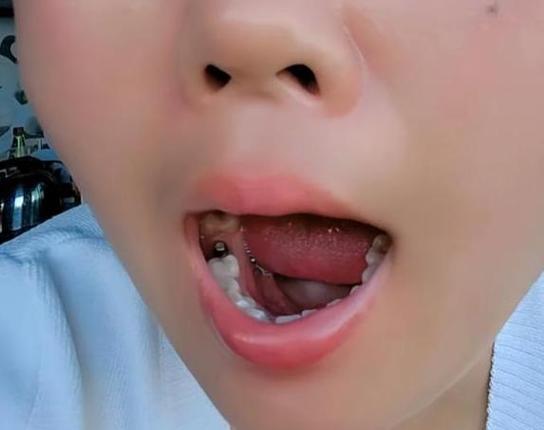 长沙55岁种牙好还是镶牙好？一文告诉你答案