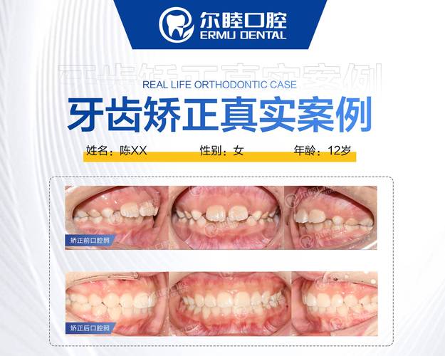 长沙深圳西乡牙齿矫正费用到底要多少钱？2026年最新价格参考