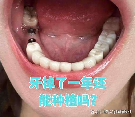 长沙牙齿掉了还能种吗？现在种牙靠谱不靠谱