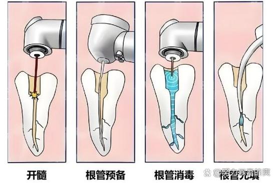 长沙种牙要等多久 最佳种牙时间全知道