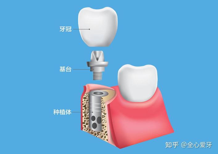 长沙佛山种植牙集采后4500元全包靠谱吗 2026最新解读