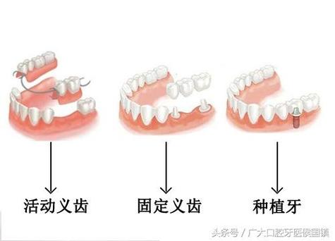 长沙儿童乳牙缺失别着急 种植牙修复方案全解