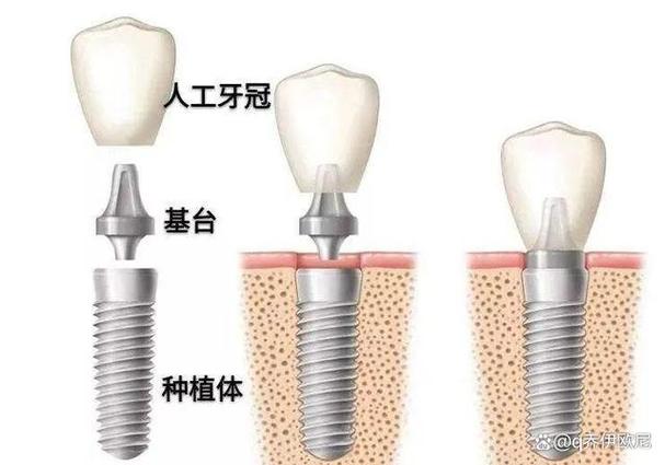 长沙集采种牙和自费种牙到底差在哪