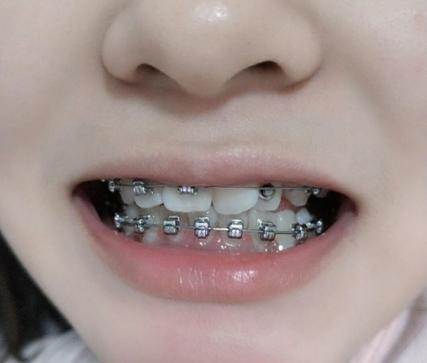 30岁做牙齿矫正有什么后遗症?_增值税缴纳逾期_mft弹簧评测