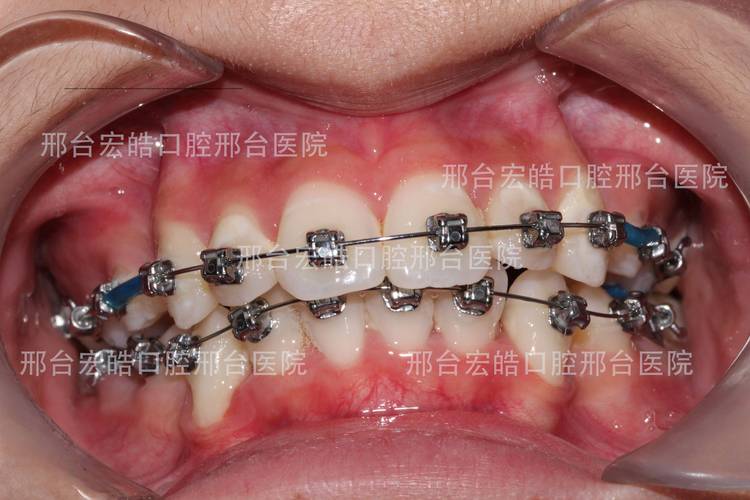 长沙不整齐牙齿矫正到底要花多少钱？大概多久能好？