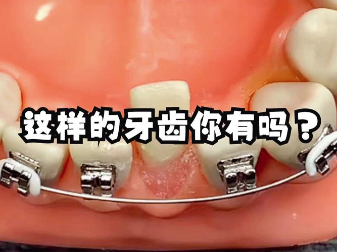长沙8岁小孩牙齿歪了能矫正吗 家长别错过最佳时机