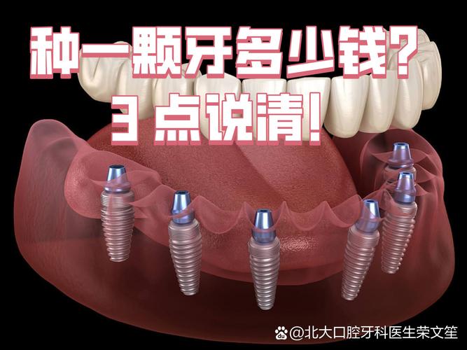 长沙沈阳种牙2026年单颗多少钱？3000到5200元能搞定吗