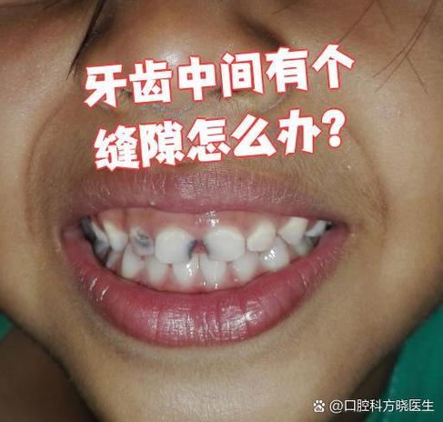 长沙门牙有缝怎么矫正？这几种方法亲测有效