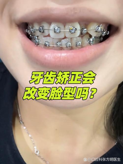 长沙18岁龅牙能矫正吗 成人正畸看这篇就够