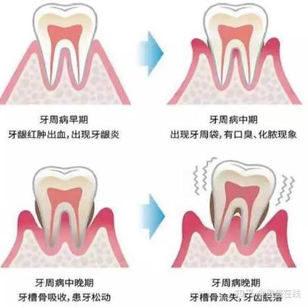 长沙三十岁还能整牙吗？成人牙齿矫正必知真相